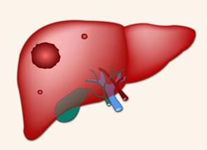 人參皂苷和肝癌放化療之間的微妙關系
