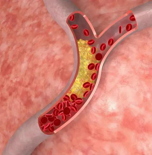 血管堵塞，身體會(huì)有這些癥狀，吃點(diǎn)冬蟲(chóng)夏草降壓降脂護(hù)血